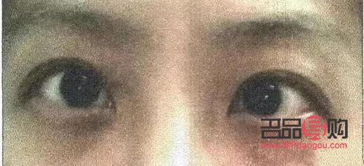 <h3>斗鸡眼矫正手术康复时间详解</h3>