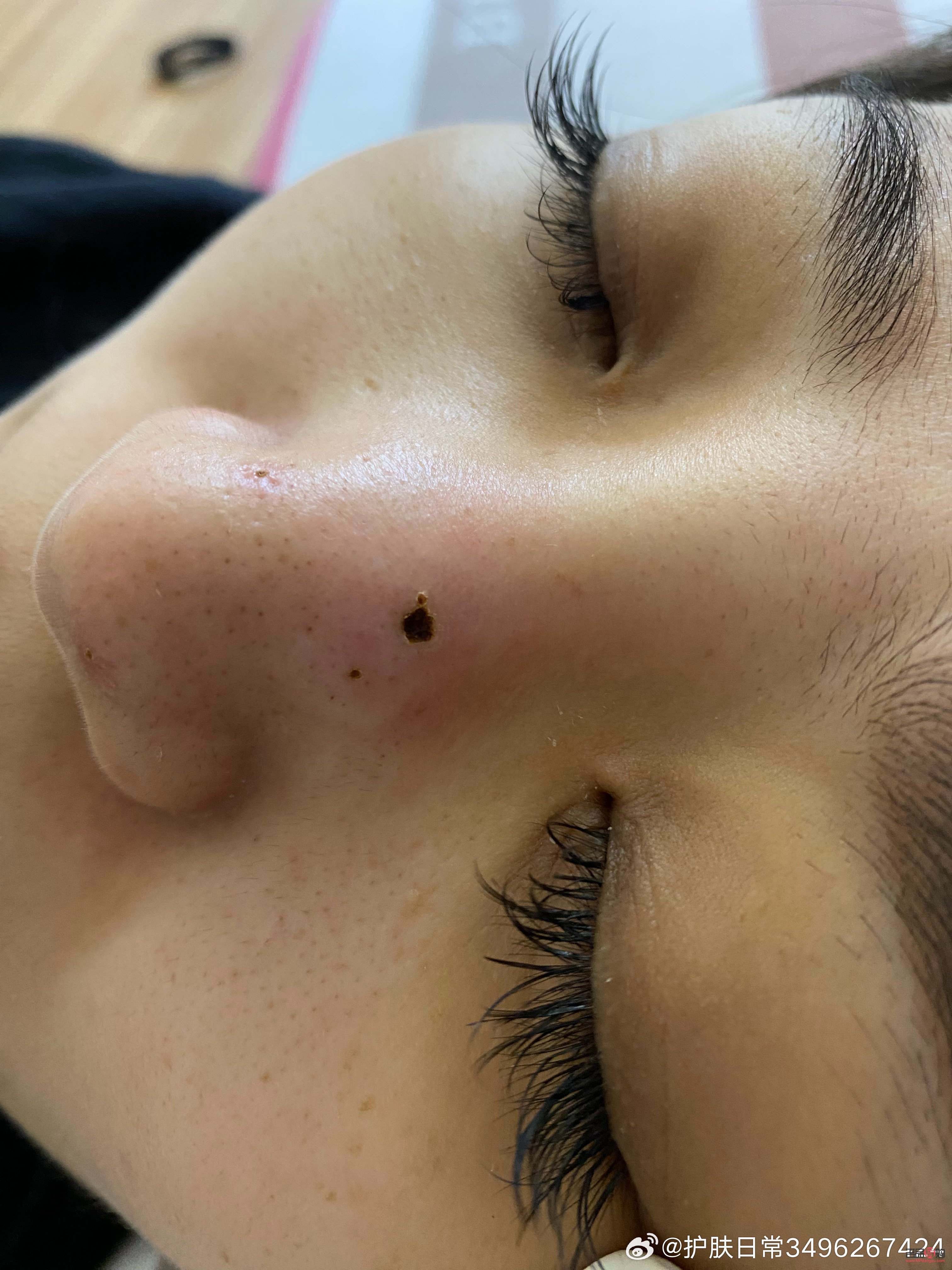 点痣美容院：专业操作与安全保障