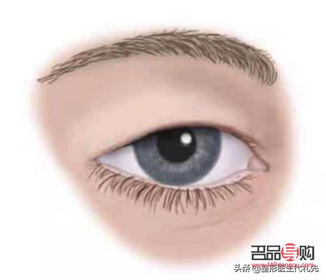 上眼皮松弛有皱纹怎么办图片(上眼皮松弛有皱纹怎么办图片大全)