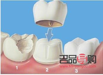 美容冠坏了怎么办(美容冠坏了怎么办图片)