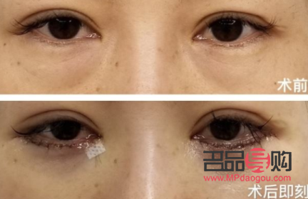 郑州割眼袋手术费一般是多少(郑州割眼袋手术费一般是多少钱)