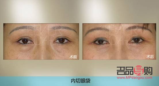 郑州割眼袋手术费一般是多少(郑州割眼袋手术费一般是多少钱)