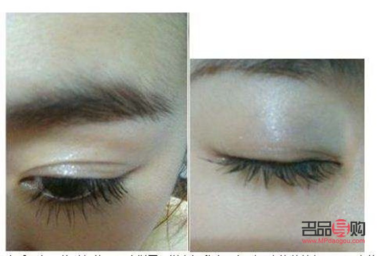 <h3>双眼皮手术：如何选择最佳方案？</h3>