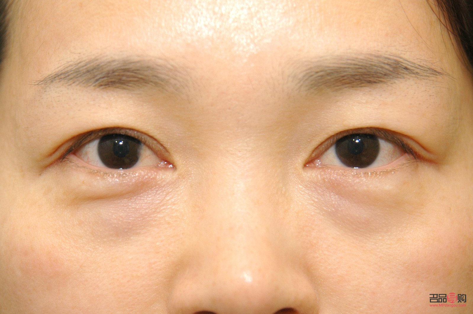 眼袋的照片(眼袋照片) 眼袋的照片(眼袋照片)