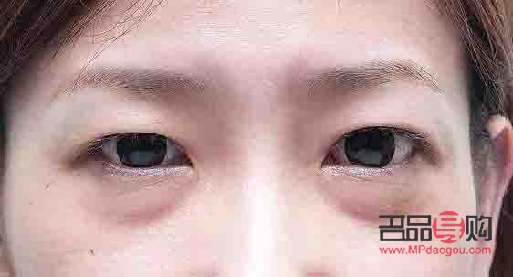 眼袋的照片(眼袋照片) 眼袋的照片(眼袋照片)