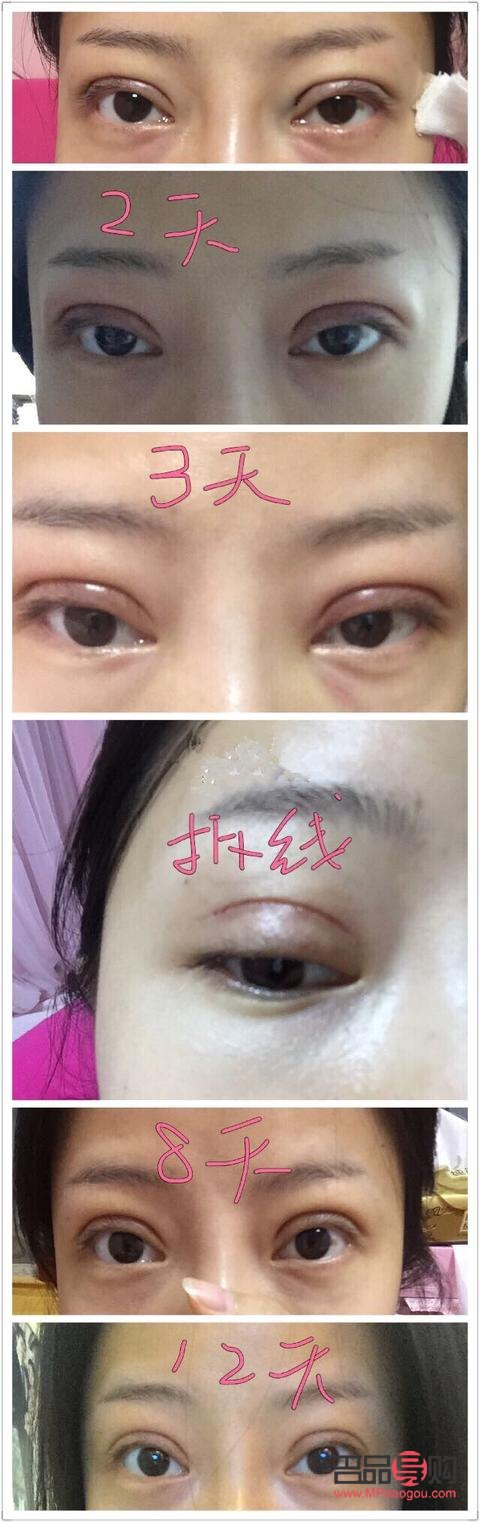 <h3>双眼皮埋线恢复期与辣食摄入指南</h3>