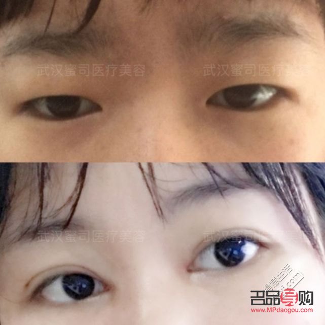 <h3>眼睛肌无力：探寻治愈之路</h3>