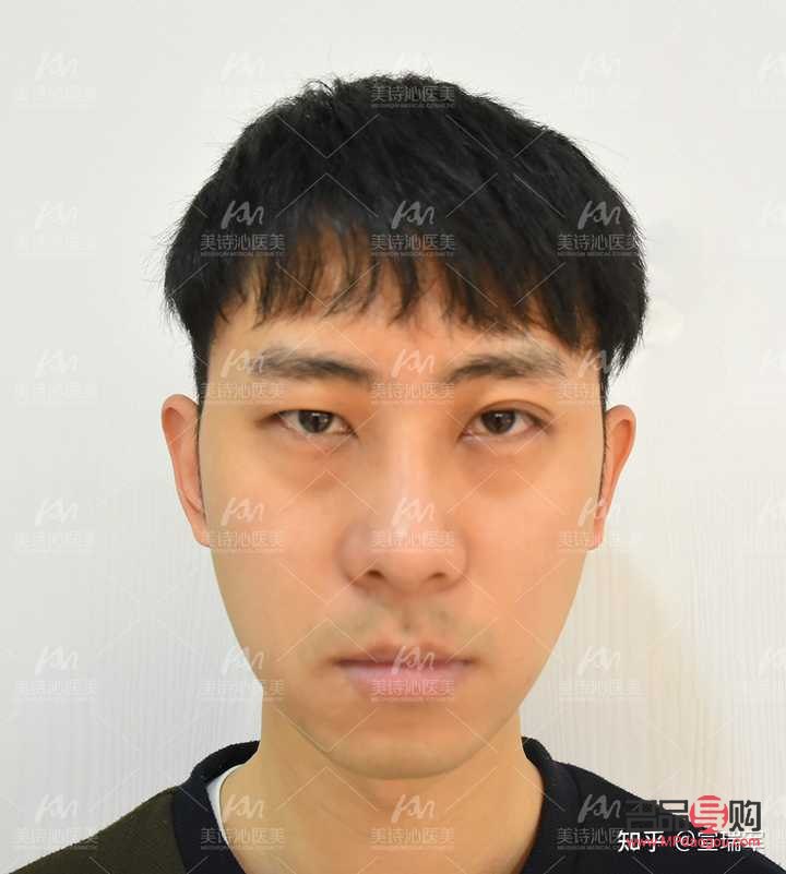 <h3>眼睛高低不对称怎么办？专业解答与实用建议</h3>