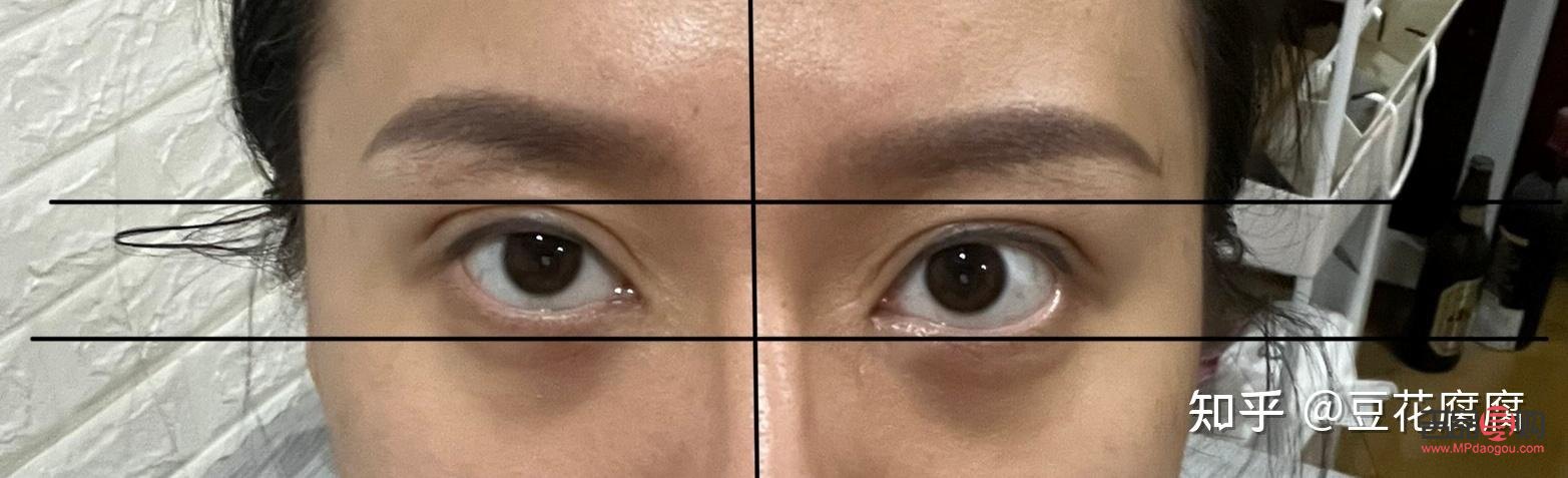 眼睛高低不对称怎么办？专业解答与实用建议