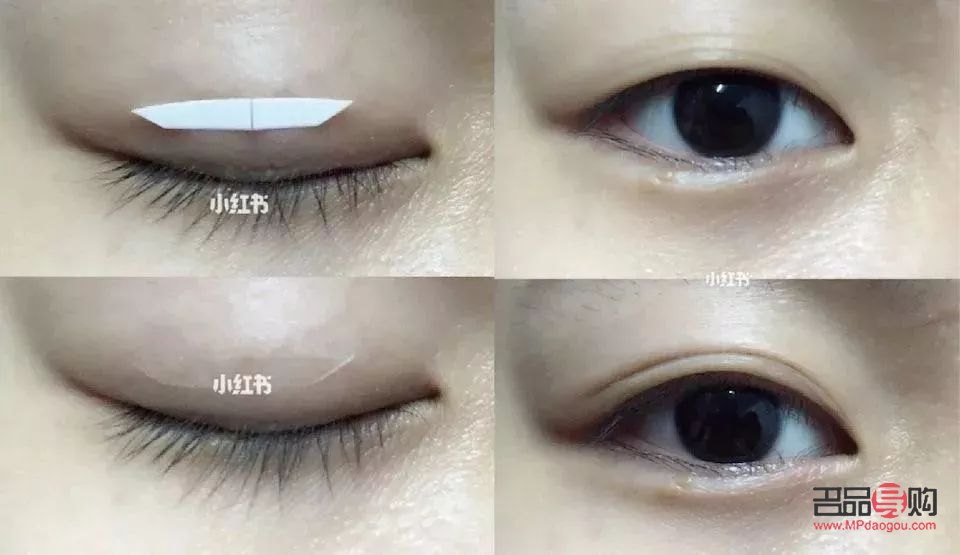 哪种双眼皮贴最舒服又好用(哪种双眼皮贴最舒服又好用的) 哪种双眼皮贴最舒服又好用(哪种双眼皮贴最舒服又好用的)