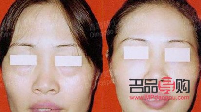 做大小眼手术要多少钱(做大小眼手术要多少钱费用)