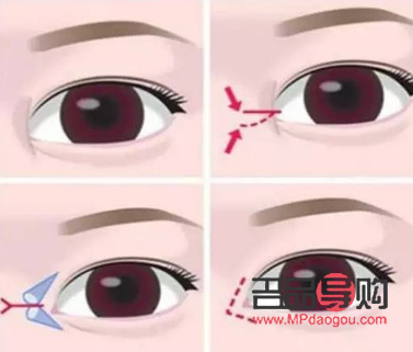 开眼角多少钱大概(开眼角多少钱?) 开眼角多少钱大概(开眼角多少钱?)