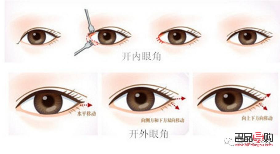 开眼角多少钱大概(开眼角多少钱?)
