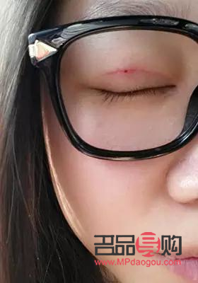 全切双眼皮与半切双眼皮:选择之美 全切双眼皮与半切双眼皮:选择之美