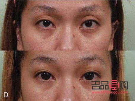 <h3>眼窝凹陷填充脂肪价格解析</h3> <h3>眼窝凹陷填充脂肪价格解析</h3>