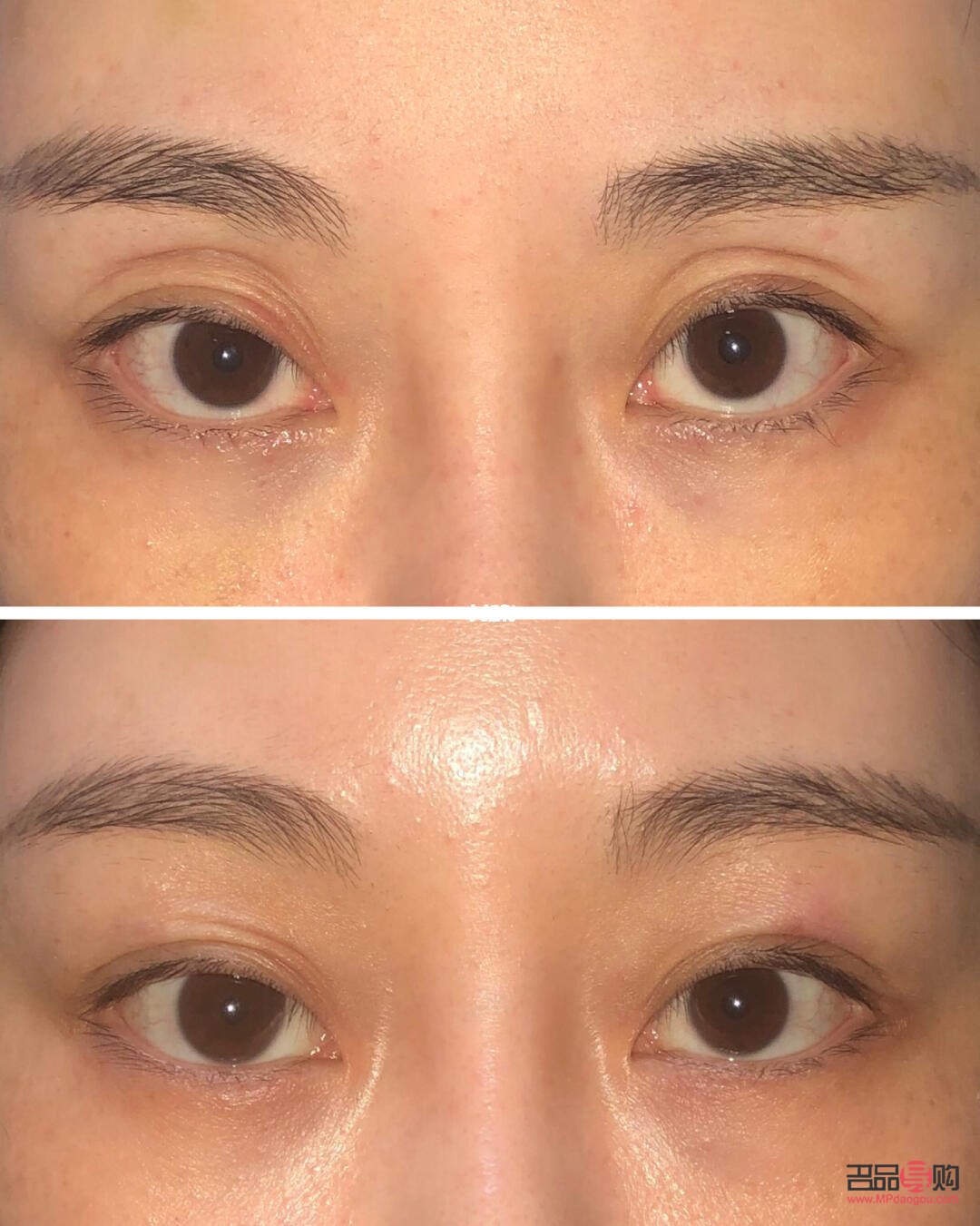 <h3>眼窝凹陷填充脂肪价格解析</h3> <h3>眼窝凹陷填充脂肪价格解析</h3>