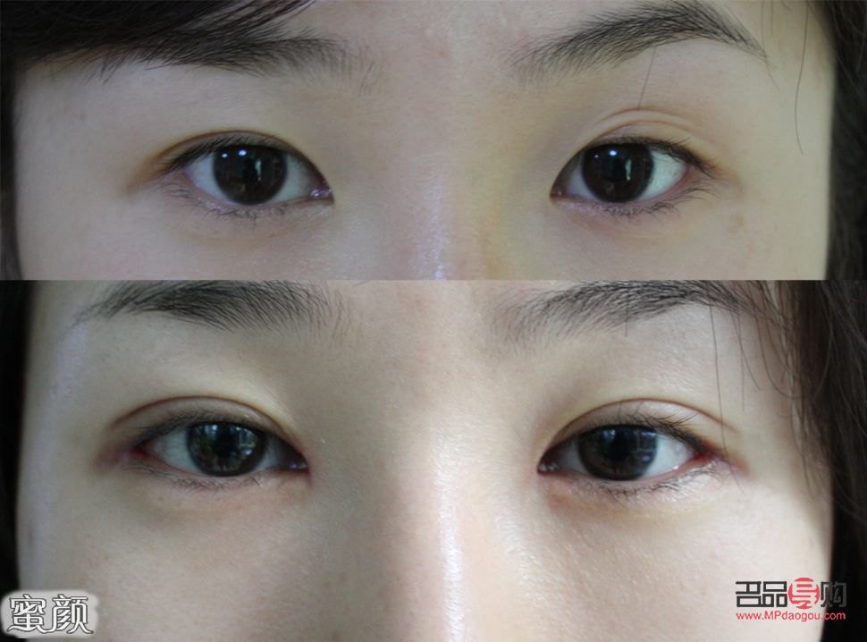 做哪种双眼皮最自然呢(做哪种双眼皮最自然呢女生)