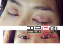 双眼皮定点是怎么弄的(双眼皮定点是什么)