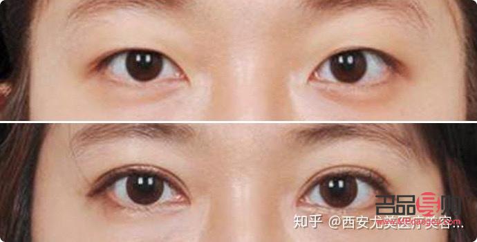 双眼皮定点是怎么弄的(双眼皮定点是什么)