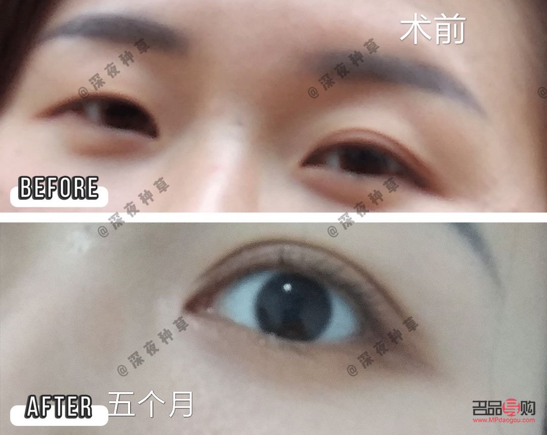 <h3>通辽割双眼皮专业机构推荐</h3>