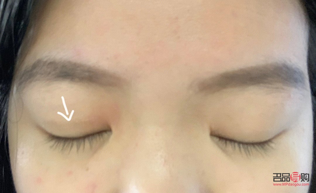 肿眼泡按摩能否有效消除？