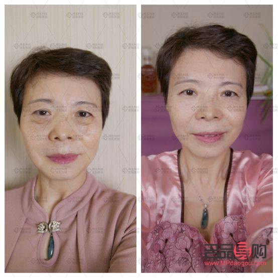 <h3>豹纹妈妈去掉眼袋价格探究</h3>