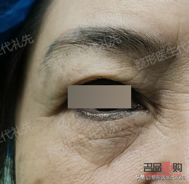 <h3>眼袋手术后的疤痕问题：能否自动消掉？</h3>