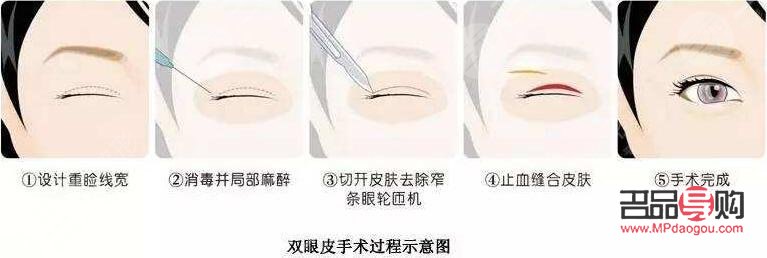 做眼部综合手术注意事项(做眼部综合手术注意事项有哪些) 做眼部综合手术注意事项(做眼部综合手术注意事项有哪些)