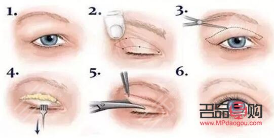 做眼部综合手术注意事项(做眼部综合手术注意事项有哪些)