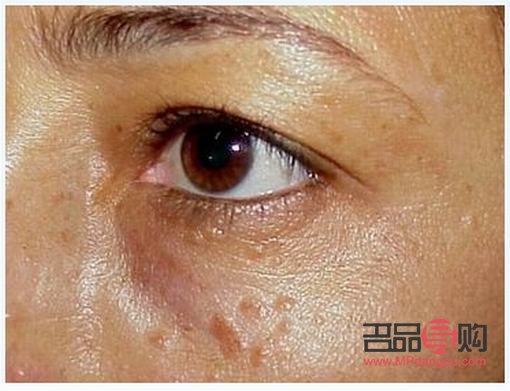 美容院去汗管瘤吗(美容院去汗管瘤吗有风险吗)