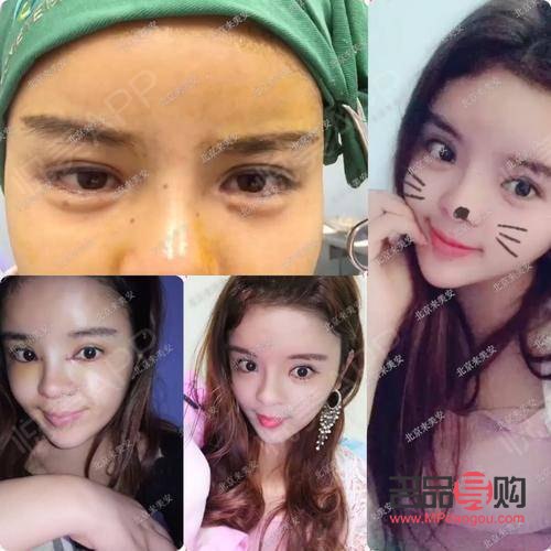 开完眼角是否能恢复到以前？