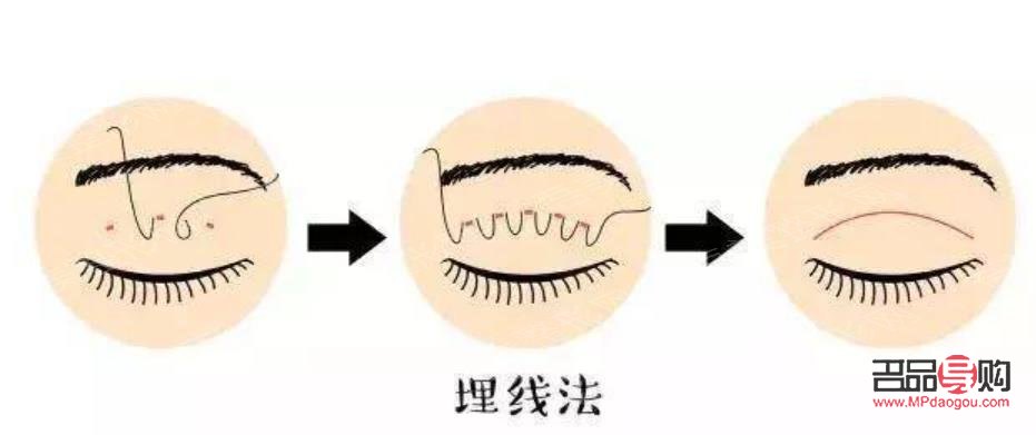 定点埋线双眼皮能维持几年(定点埋线双眼皮能维持几年呢)