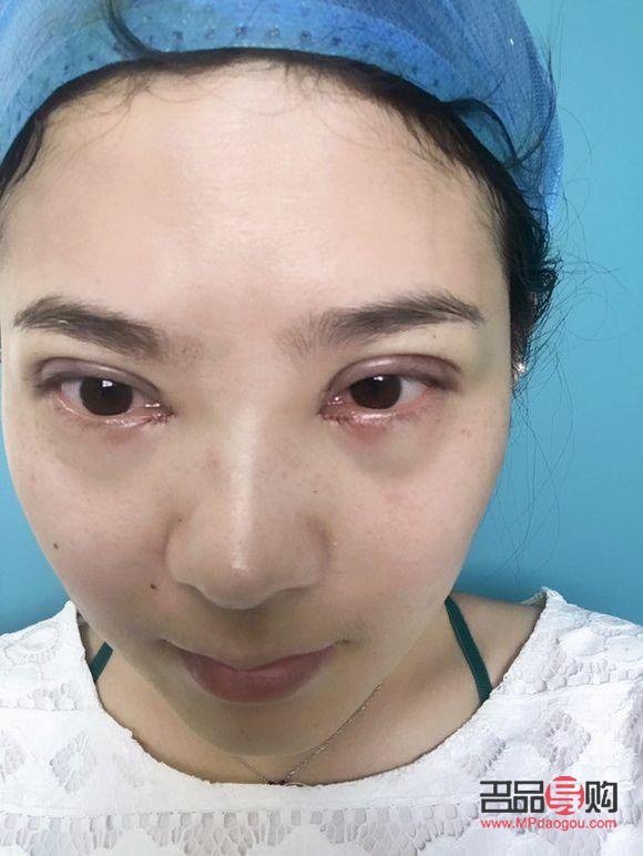 定点埋线双眼皮能维持几年(定点埋线双眼皮能维持几年呢)