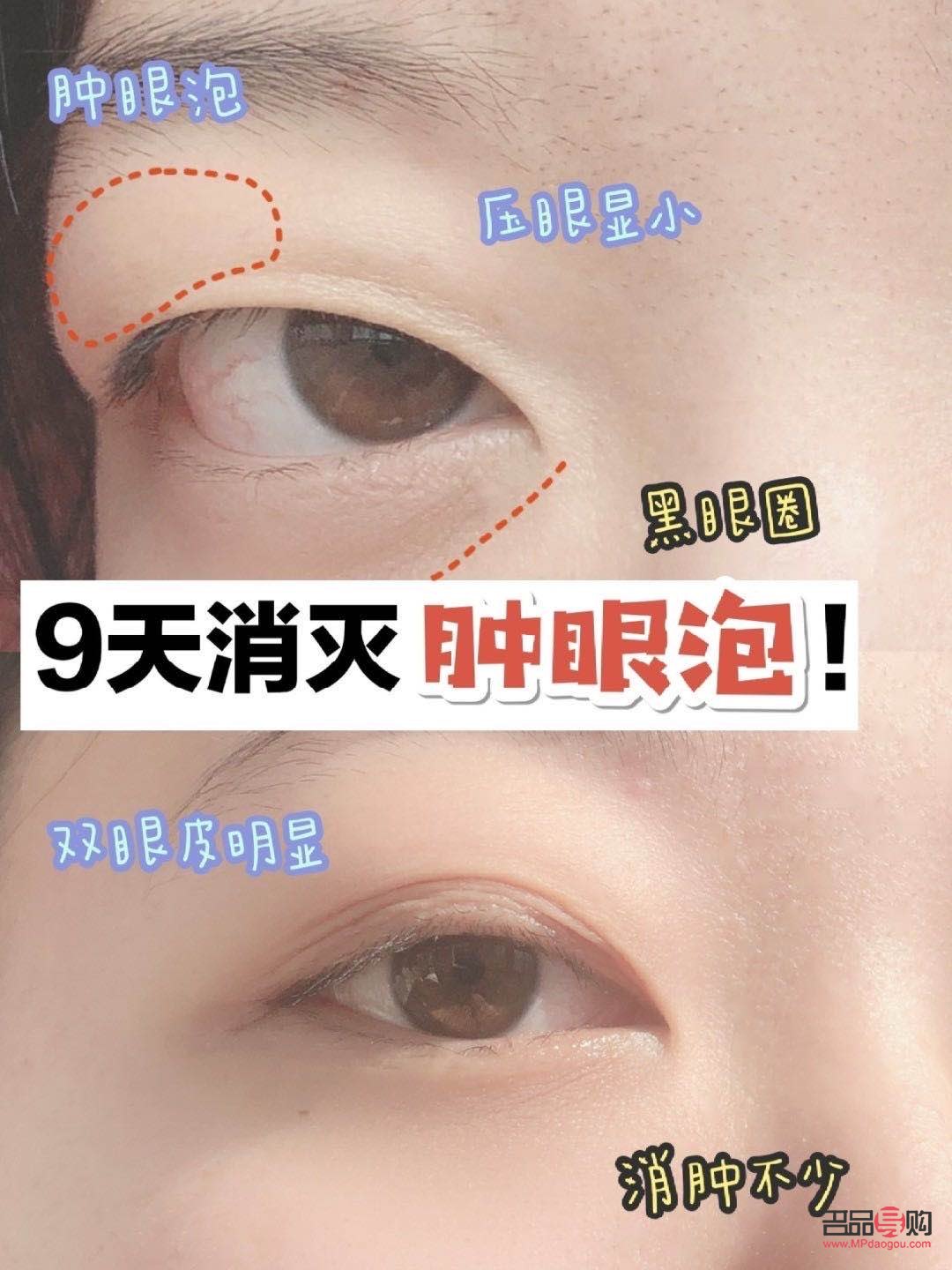 肿眼泡除了手术还有什么办法(肿眼泡除了手术还有什么办法消肿)