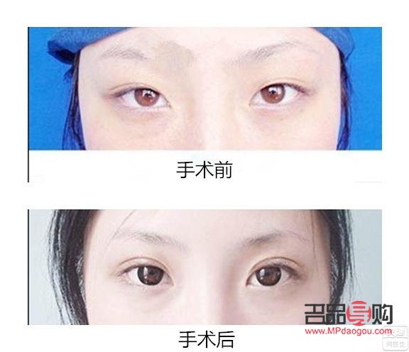 割双眼皮大概多久可以出门(割双眼皮大概多久可以出门散步) 割双眼皮大概多久可以出门(割双眼皮大概多久可以出门散步)