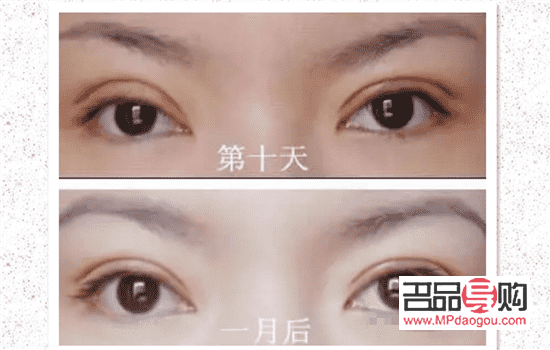 割双眼皮大概多久可以出门(割双眼皮大概多久可以出门散步) 割双眼皮大概多久可以出门(割双眼皮大概多久可以出门散步)