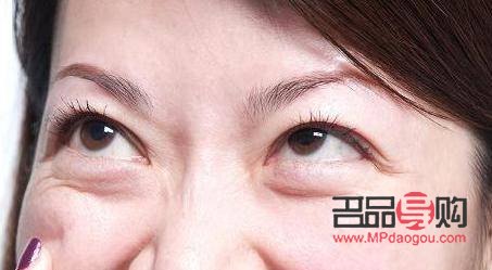 <h3>内切去眼袋手术后的恢复时间及注意事项</h3>