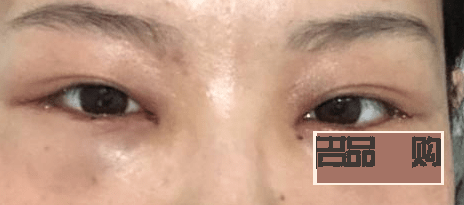 内切去眼袋手术后的恢复时间及注意事项