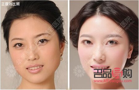 上眼皮松弛适合做什么样的双眼皮(上眼皮松弛适合做什么样的双眼皮呢)