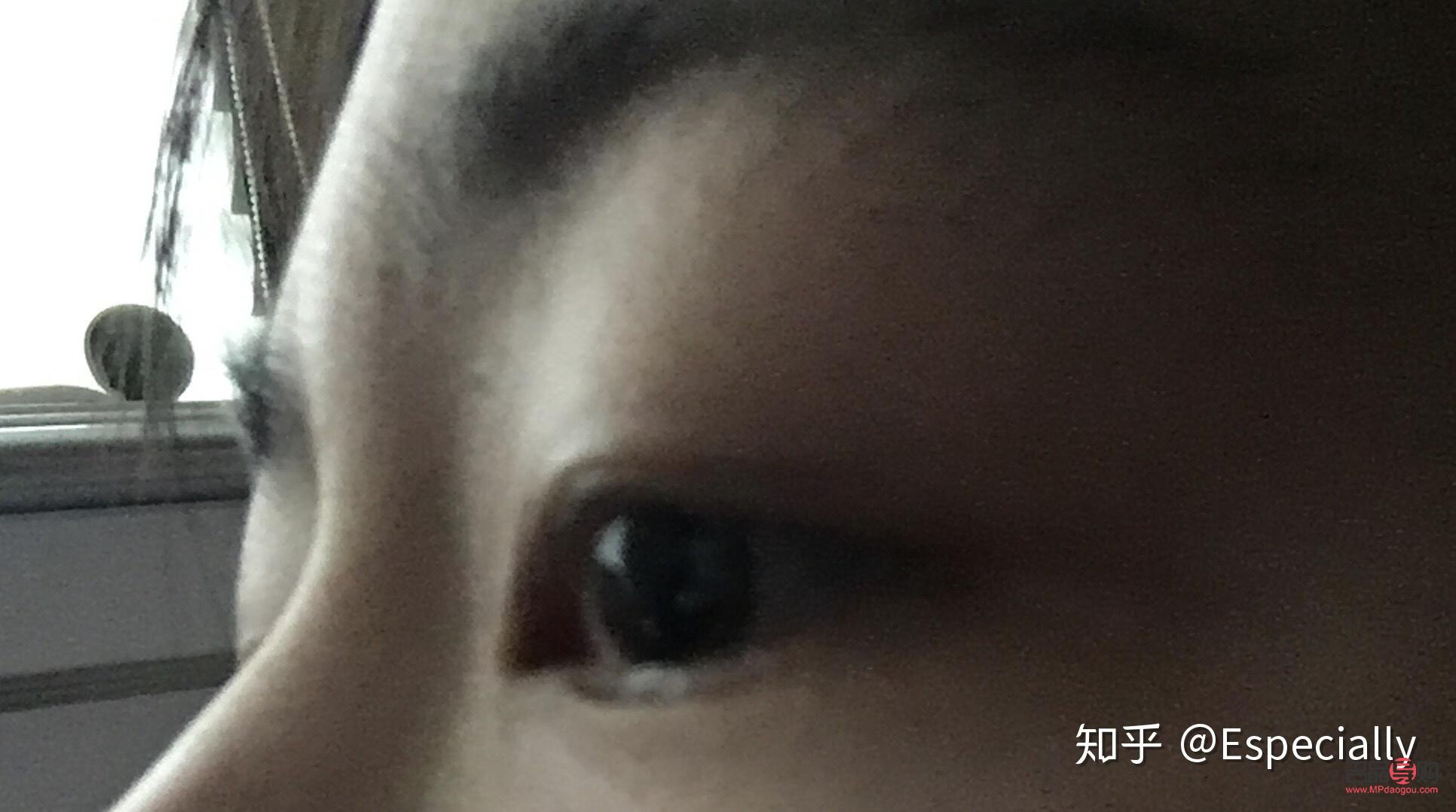 鱼泡眼用什么药消肿效果好(鱼泡眼用什么药消肿效果好一点)