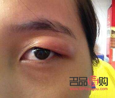 鱼泡眼用什么药消肿效果好(鱼泡眼用什么药消肿效果好一点)