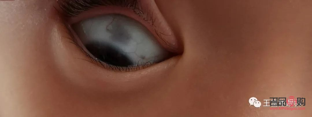 眼睛白色部分有黑色斑块(儿童眼睛白色部分有黑色斑块)