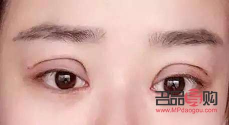 开眼角手术一般需要多久恢复自然(开眼角手术一般需要多久恢复自然图片)