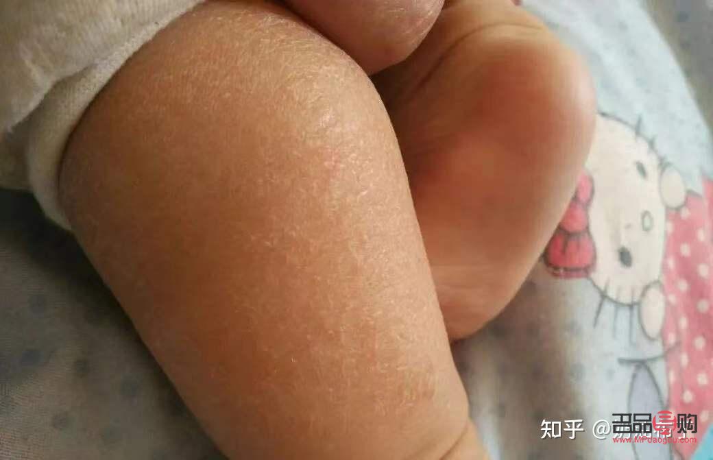 宝宝身体干燥怎么护理(宝宝身体干燥怎么护理最好)