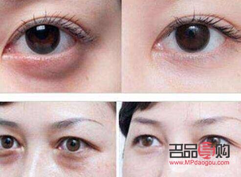 美容院眼袋怎么去(美容院眼袋怎么去除最有效)