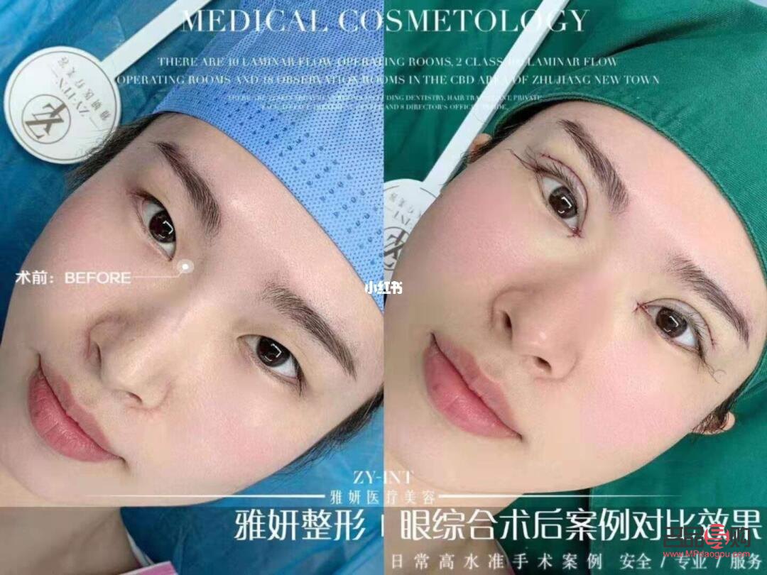 眼综合真的好看吗(眼综合值得做吗) 眼综合真的好看吗(眼综合值得做吗)