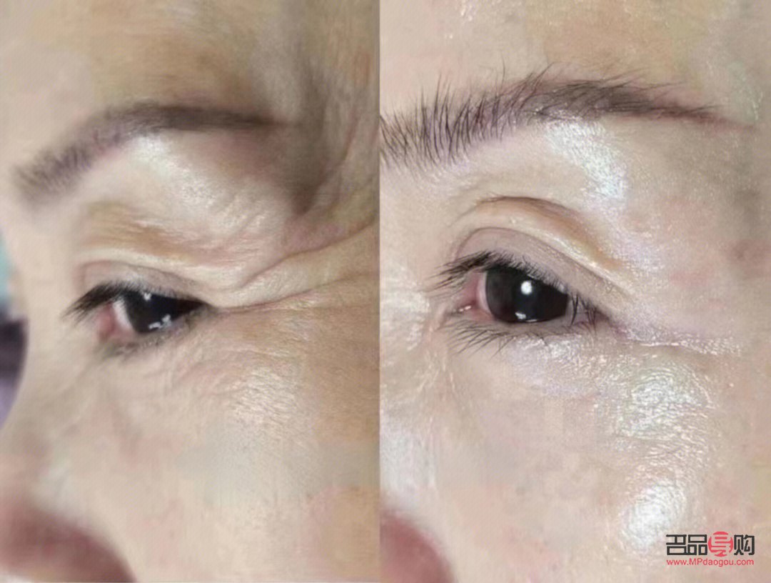 眼部除皱图片(眼部除皱图片大全) 眼部除皱图片(眼部除皱图片大全)