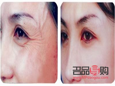 眼部除皱图片(眼部除皱图片大全) 眼部除皱图片(眼部除皱图片大全)