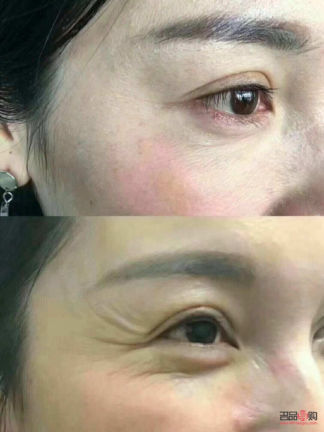 眼部除皱图片(眼部除皱图片大全)