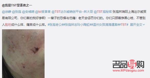 <h3>身体烂掉如何有效护理？</h3>